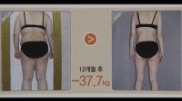 '똑소리', 위밴드 수술 안전성-저가 셀카봉 함정 다룬다