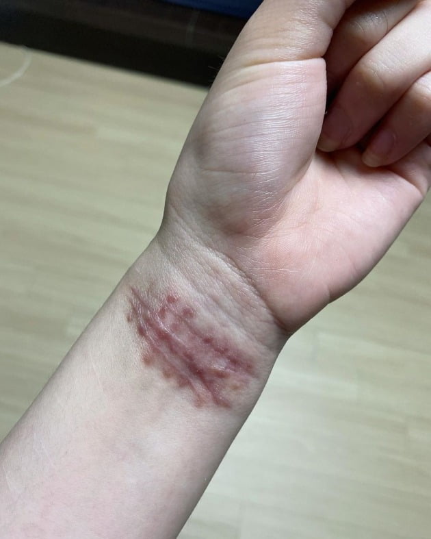 배우 권민아가 과거 극단적 선택으로 남은 흉터를 공개했다./ 사진=권민아 인스타그램