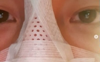 한정수, 코뼈 골절 부상 "농구하다가"