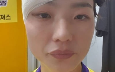 안영미, 퉁퉁 붓고 피멍 든 눈…붕대 투혼 "이제 괜찮아" [TEN★]