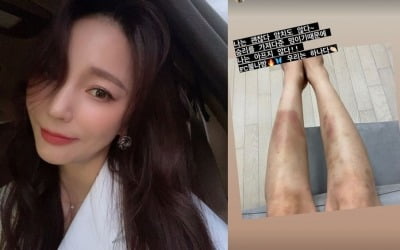 안혜경, 축구에 이렇게 진심일 수가! 시퍼런 피멍에도 행복 "승리 가져다줬다" [TEN★]