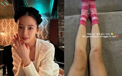 아이린, 온 다리에 멍이…부럴질 것 같은 각선미 '충격' [TEN★]