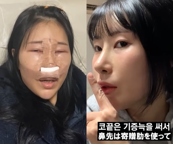 이세영, 대박 난 코성형…충격적인 붓기→완벽한 버선코 "만족스럽다" [TEN★]