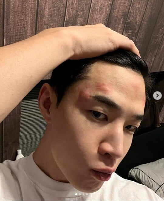 헨리, 퉁퉁 부은 얼굴로 "진짜 복수할 수도 없고" 분노…무슨 일? [TEN★]