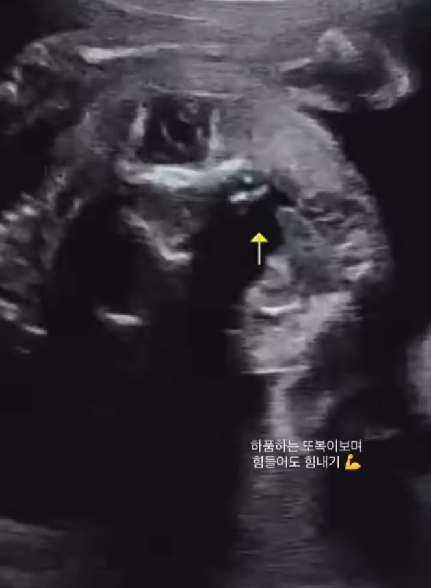 '사업가♥' 최희, 출산보다 임신이 힘든 예비 둘째맘 "만삭만큼 배 나왔다"