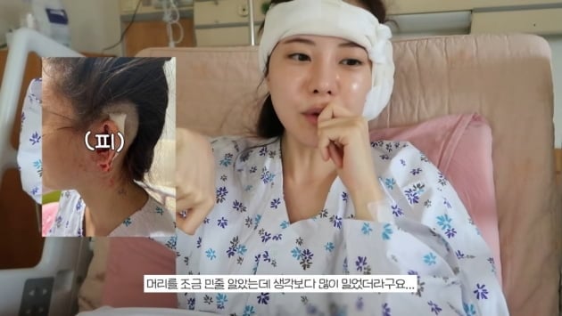 아옳이, 진주종 수술 위해 옆머리 삭발 "조금 민줄 알았는데..."