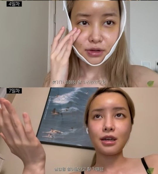 [종합] 유깻잎, 지방이식·윤곽 수술…"6시간 수술, 남친이 도라에몽이라고"