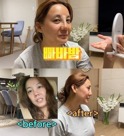 [종합] 고은아, 코 재성형한다…"조직 죽어있고 엉켜있는 상태"('방가네')