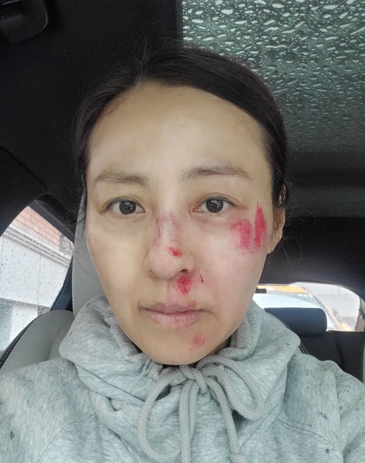 끔찍한 사고 당했다…전혜진, 피와 진물 범벅 얼굴 공개