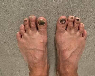발톱 6개 빠진 션, 세계 달린다…"4개 멀쩡해 뛸 수 있어"