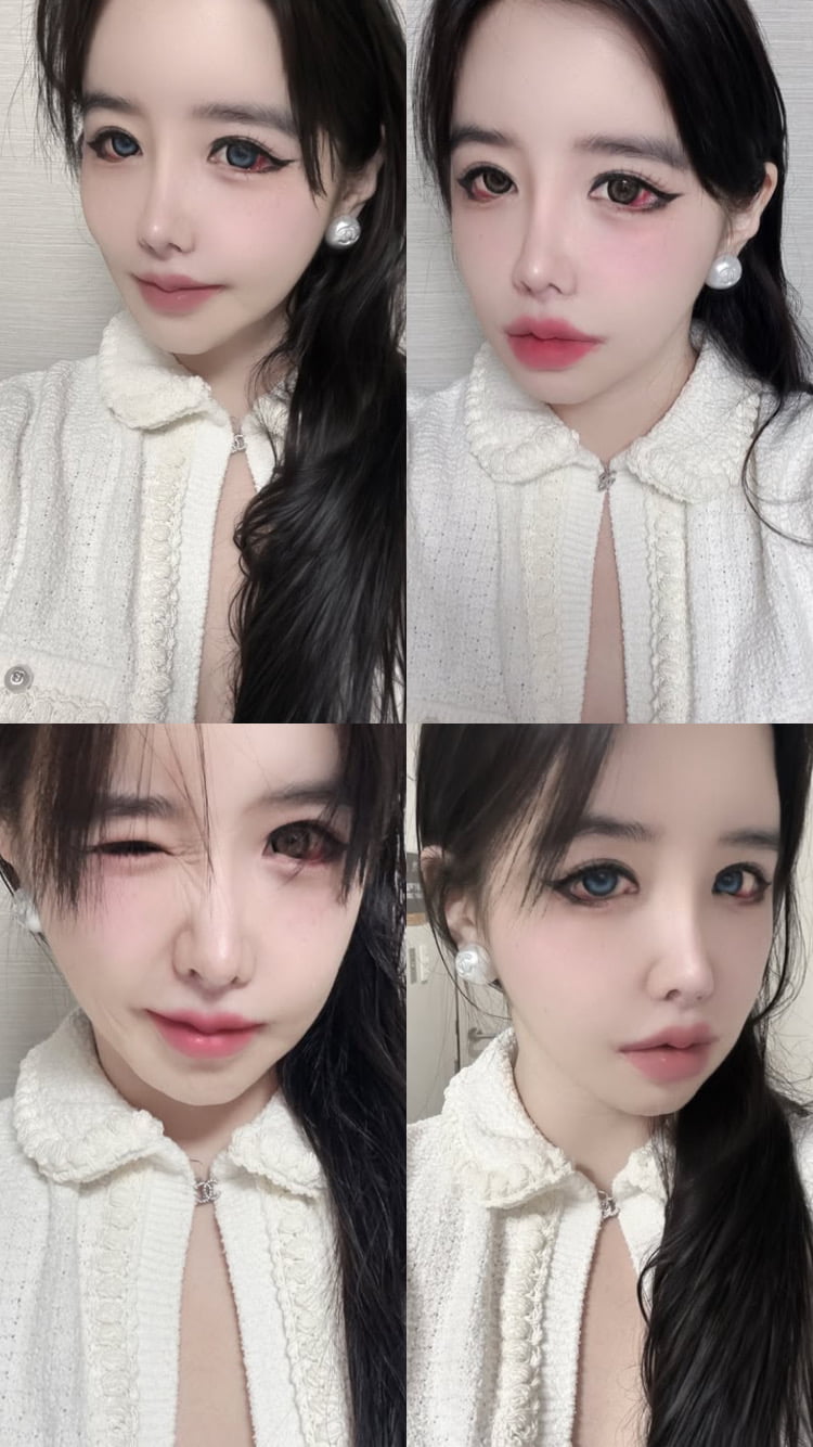 눈 실핏줄 다 터졌네…박봄, 누가봐도 건강 적신호