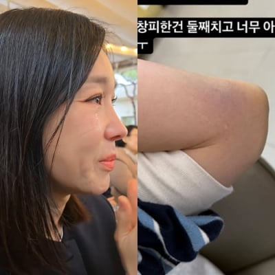 이지혜, 직접 알린 부상 소식…"창피한 건 나중" 멍 확장 시작