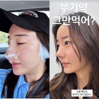 "붓기 거의 없어"…'조혜련 올케' 박혜민, 세 번째 코 성형 대만족