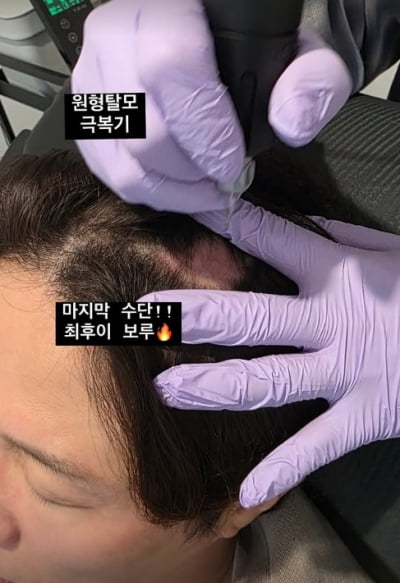 '43세' 박성광, 텅 비어버린 핑크빛 두피→탈모 복구 나섰다