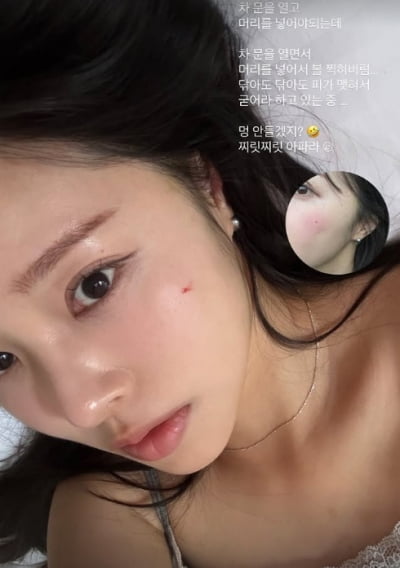 '암투병 고백' 이솔이, 갈비뼈로 걱정 자아내더니…결국 피 봤다