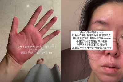김지혜, 쌍둥이 임신 중 응급실 행…"온몸 빨개지고 두드러기 올라와"