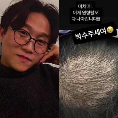 '43세' 박성광, 탈모 치료 37일 만에 기적 만들어…"여러분 박수 주세요"