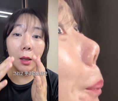 허안나, 코 성형 부작용 호소…"구축 와, 코가 삐뚤어지다니"
