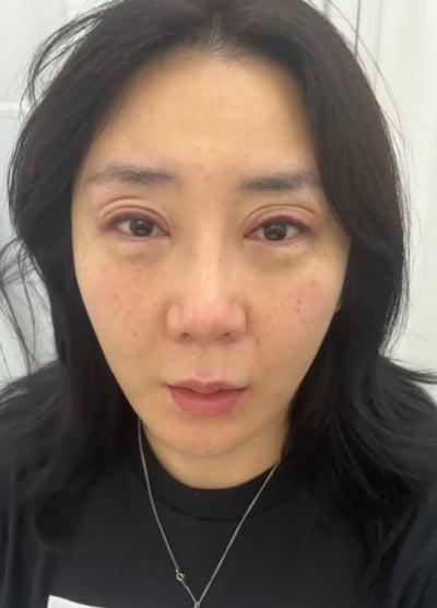 허안나, 시술 직후 눈이 시뻘게…20년 만에 문신 지운 생생한 후기