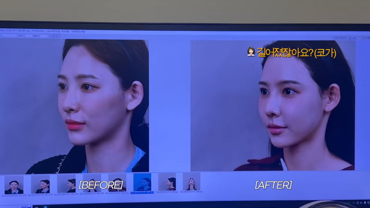 이나연 아나, 코 성형 또 할까…“옛날 얼굴 그리워” 복원 고민