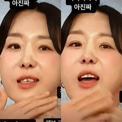 '인중 축소술' 이지혜, 결국 방송서 부작용 드러났다…시청가 제보, 사건으로 남아