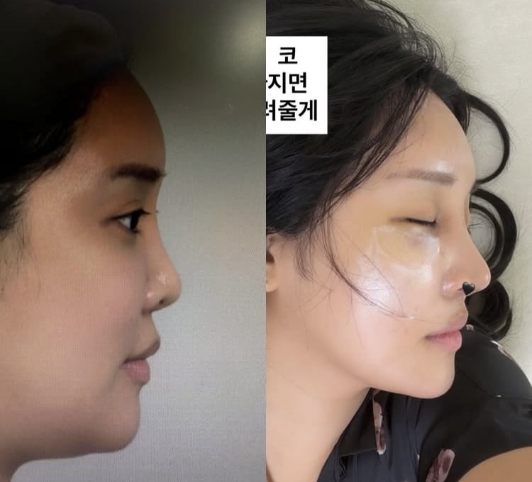 랄랄, 낮은 코에서 오똑한 코로…성형 전후 공개