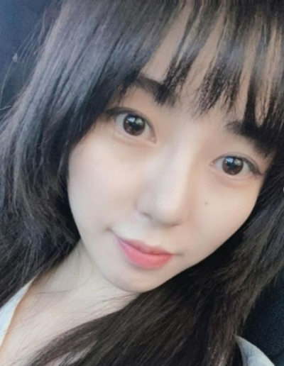 권민아, 얼굴에 '심재성 2도 화상'…회복 더디고 흉터 쉽게 남는 특징 가지고 있어 [전문]