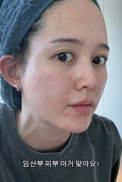 "이게 맞아요?"…남보라, 심각한 피부 상태→임산부 스트레스 호소