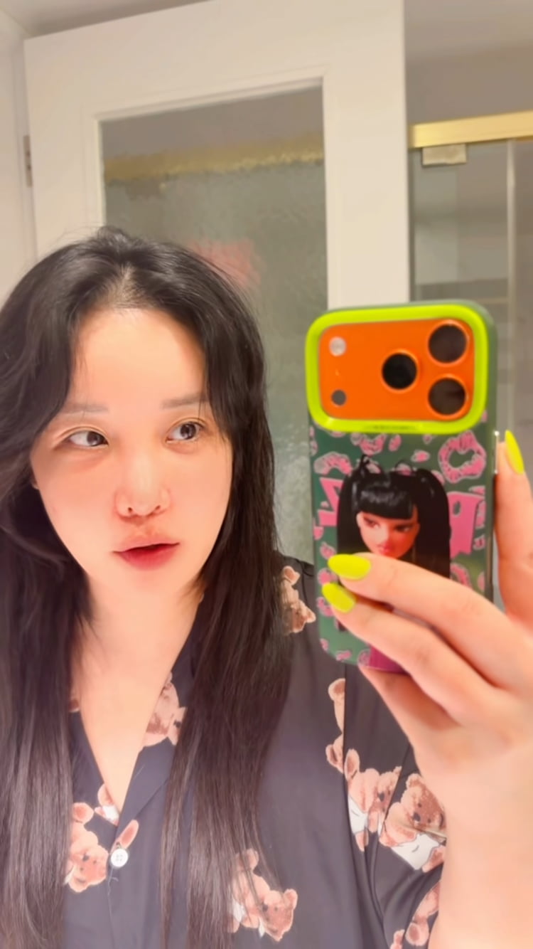 랄랄, 코 성형만 3번째라 베테랑…부기 싹 빠진 모습