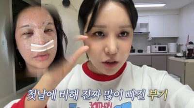 랄랄, 코 재수술만 3번째…"'의료법 위반' 문의 많다"