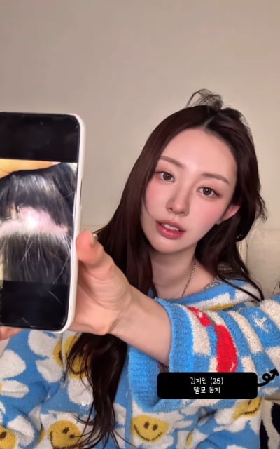 '환연' 지연, 원형탈모가 너무 심해…두피 속 500원 크기 구멍이 뻥