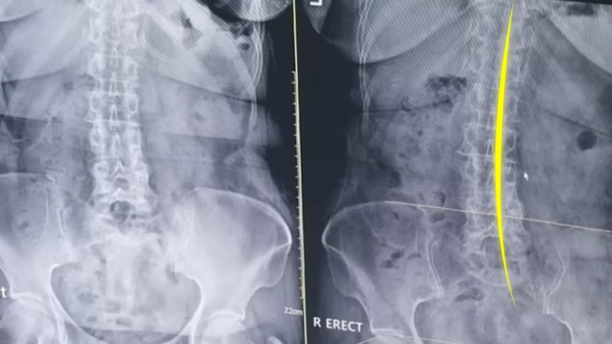 선우용여, 왼쪽으로만 3번 넘어져…깁스 빨리 푼 게 문제였나