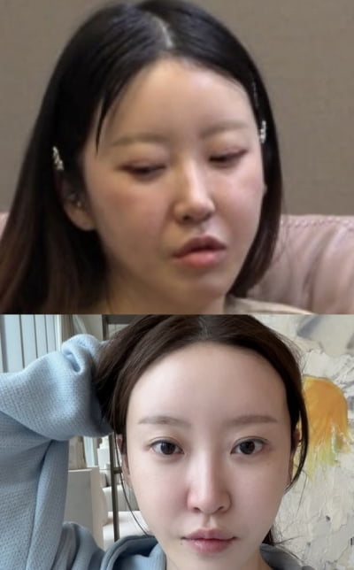 20기 정숙, 2일 내내 응급실 다녀왔으면서…관리 전후 보여주며 팔이피플 인증