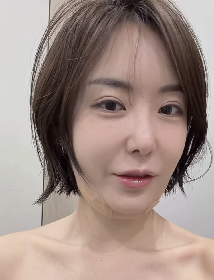 ‘가슴 성형 1000만원’ 이소라, 피부과 VIP네…이중턱 붓기 깜짝