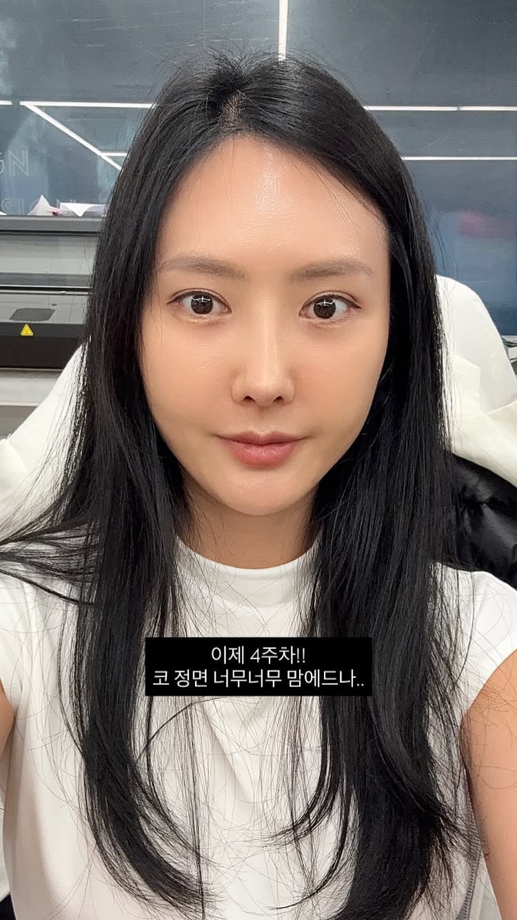 ‘돌싱’ 변혜진, 코 재수술 했다더니…이제 4주차, 붓기가 없네
