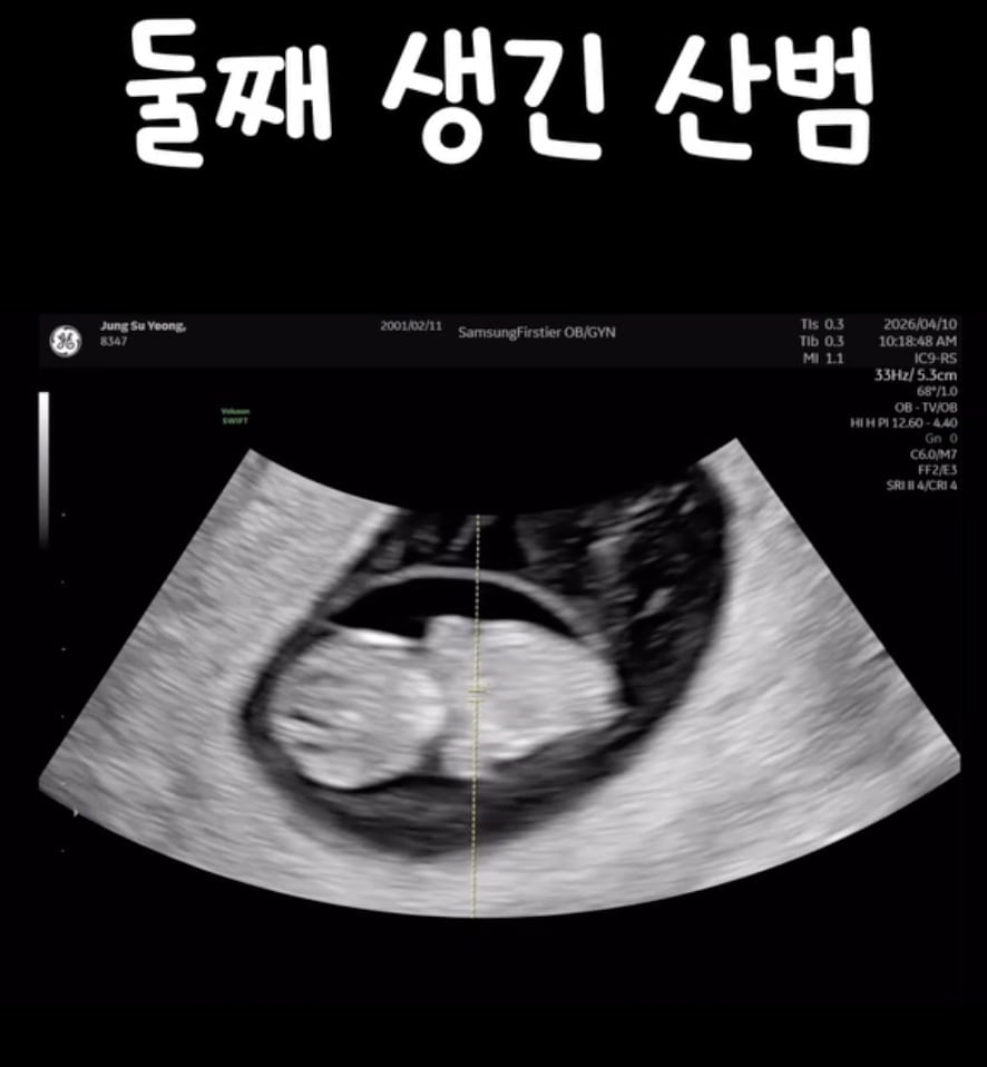 산범 초음파 / 사진 = 산범 SNS