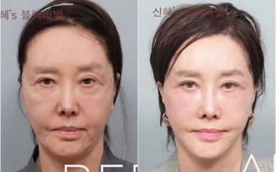 "60대 맞아?"…유혜리, 안면거상 수술 후 달라진 비주얼 '깜짝'