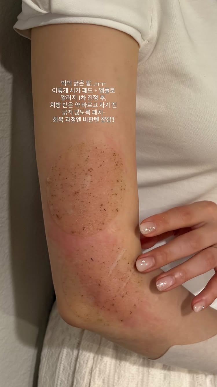 이아영, 재혼 3개월 남았는데…하와이서 알러지로 고생중