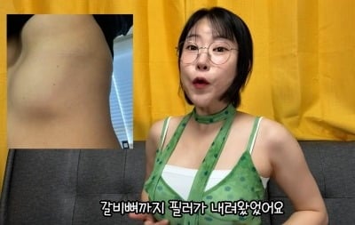 '1억 성형' 이세영, 필러 부작용 사진 공개..."가슴이 4개, 갈비뼈까지 내려와"