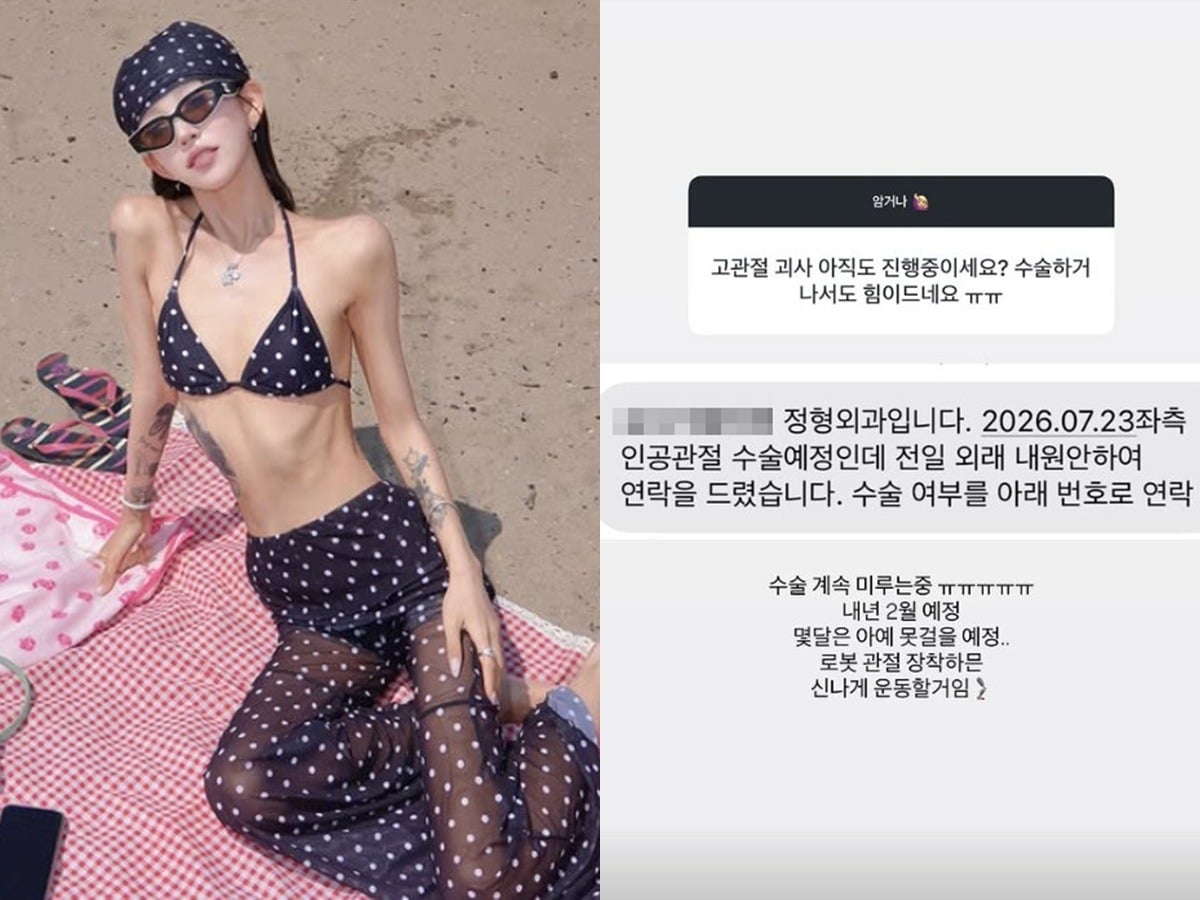골반 괴사를 알렸던 최준희가 인공관절 수술 소식을 전했다. / 사진=최준희 SNS