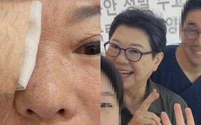 '73세' 양희은, 각막이식 수술 한 달 만에 붕대 풀고 '미소 활짝'…조만간 방송 복귀하나