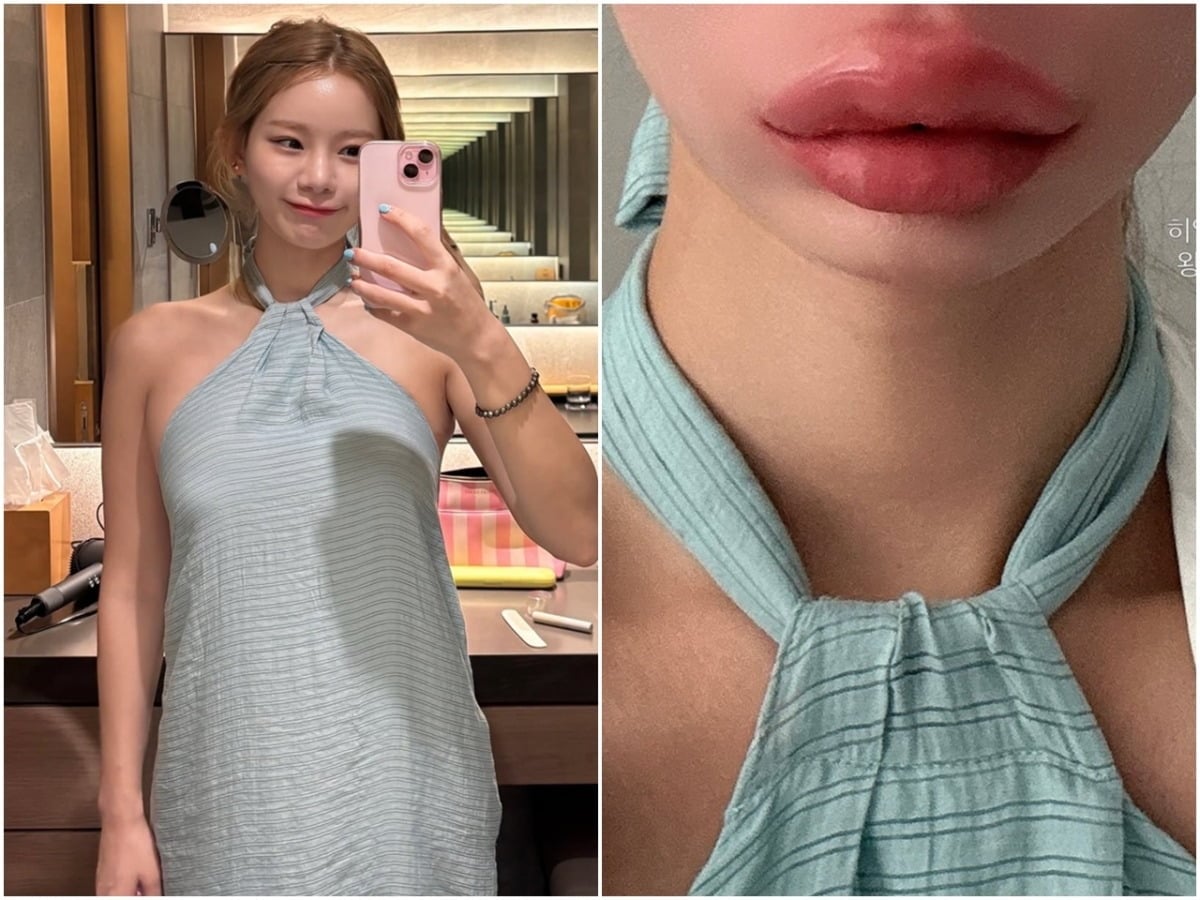 맹승지가 입술 필러 제거 시술을 받은 근황을 전하며 시술에 대한 주관을 밝혔다./사진=맹승지 SNS