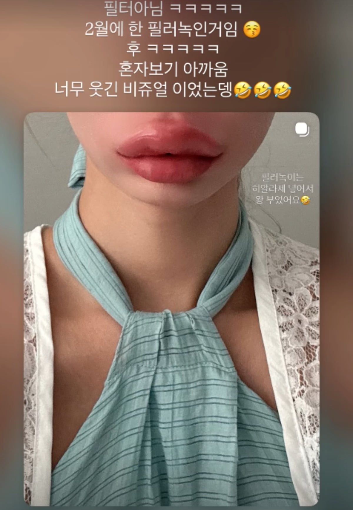맹승지가 입술 필러 제거 시술을 받은 근황을 전하며 시술에 대한 주관을 밝혔다./사진=맹승지 SNS