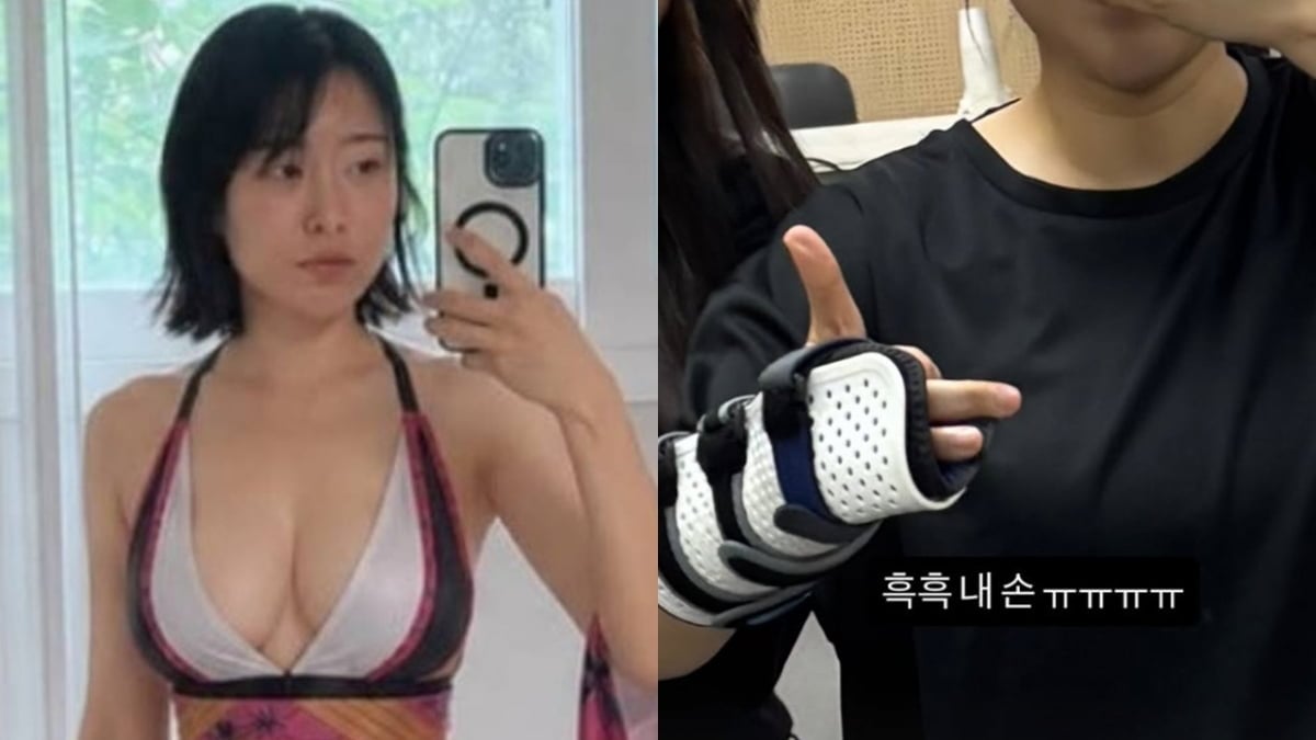(오른쪽) 코미디언 이세영이 다친 손을 인증하고 있다. / 사진=이세영 SNS