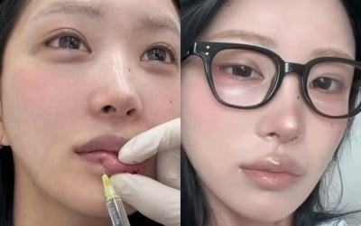 '최진실 딸' 최준희, "18세부터 필러 맞아" 쿨 고백…확 달라진 인상 이유 있었네