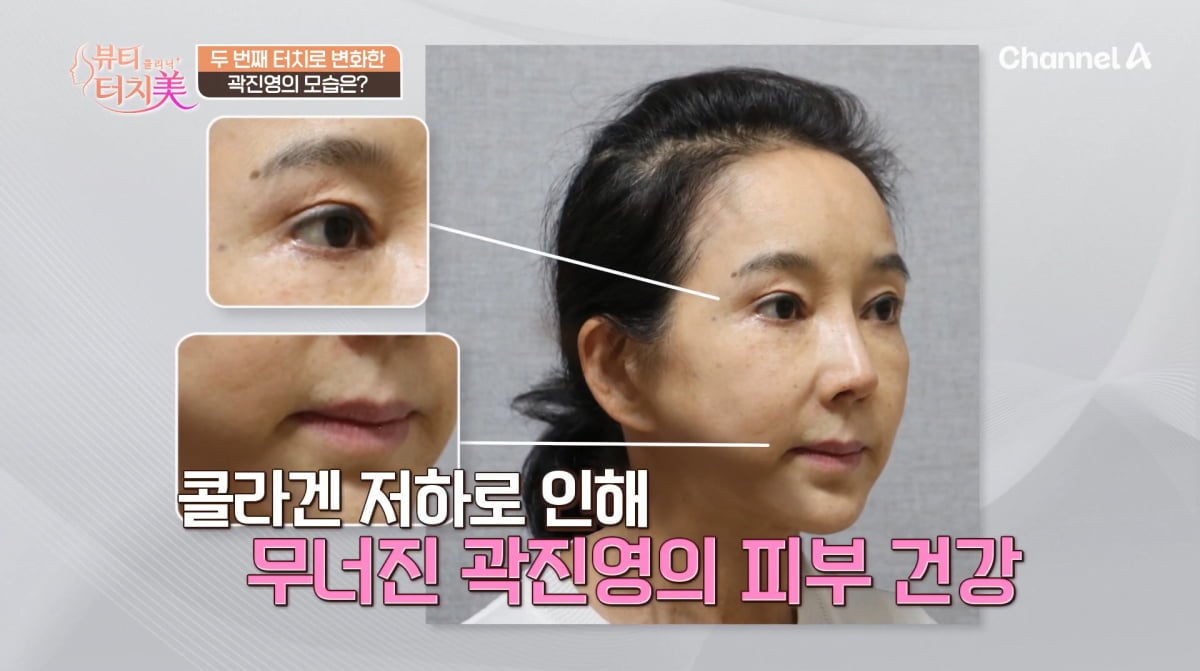 사진=채널A '뷰티 클리닉 터치미'