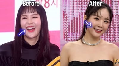 "전현무가 소개해줘서 시술받아"…장영란, 예뻐진 비결 있었다 "앞니 작아져" ('A급')