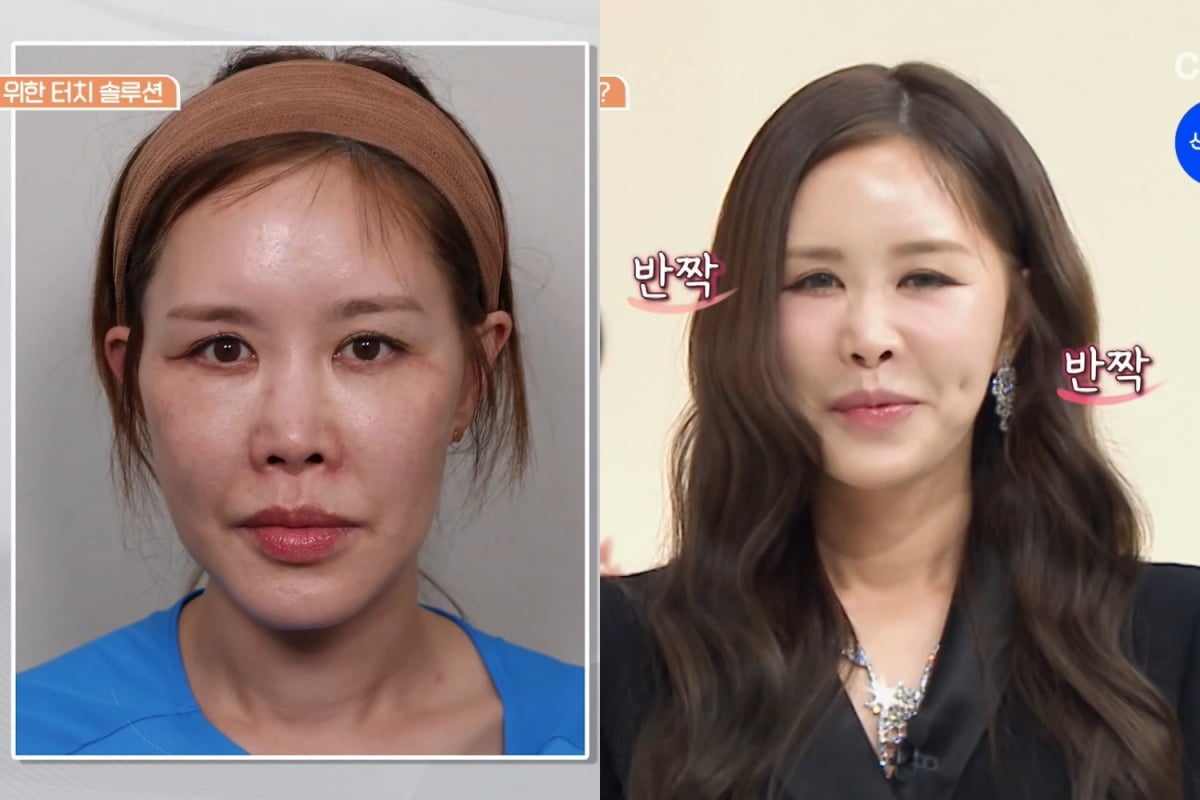 사진=채널A '뷰티 클리닉 터치미'