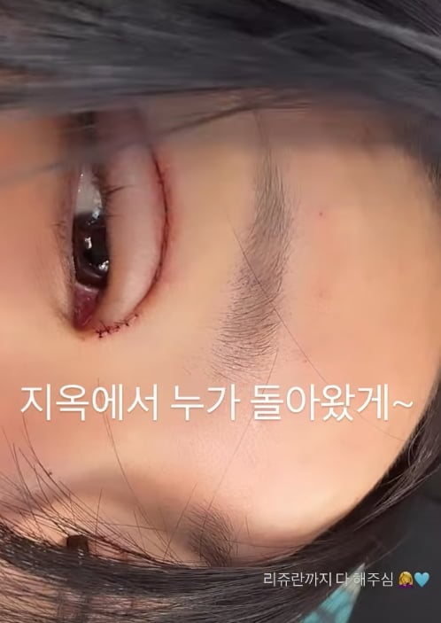 배우 고(故) 최진실의 딸이자 인플루언서 최준희가 눈 성형수술 직후 근황을 공개했다./ 사진=SNS