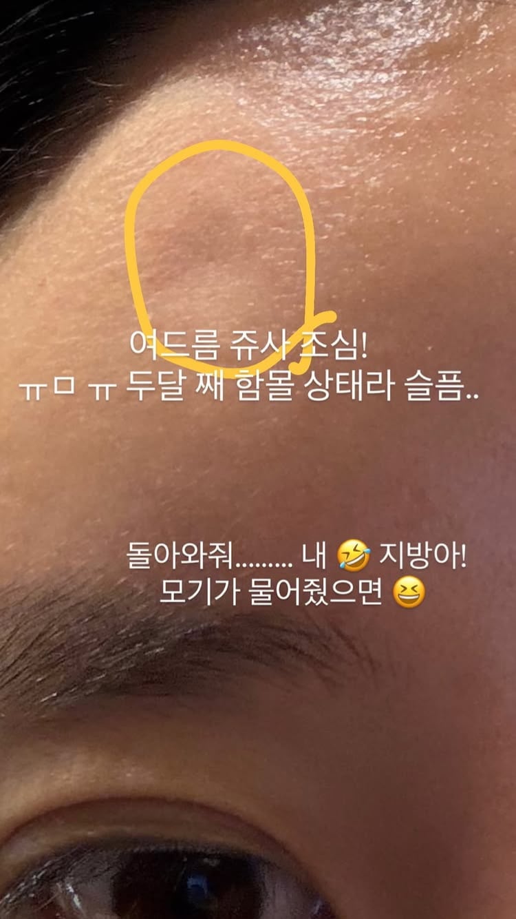 조현, 주사 맞고 2개월째 피부 함몰됐다…푹 들어간 지방에 ‘모기’ 소환